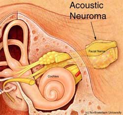Acoustic Neuromas & Tinnitus