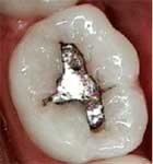 Silver Fillings: Mercury Risks for Health, Hearing and Tinnitus