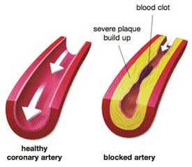 The Blood Thinning Properties of Gingko