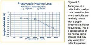 Audiograms: Presbycusis and Noise-Induced Hearing Loss