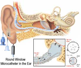 Excitotoxicity & New Medications for Tinnitus