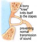 Stapedectomy for Otosclerosis