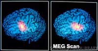 Magnetoencephalography (MEG) for Pinpoint Tinnitus Imaging
