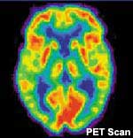 Magnetoencephalography (MEG) for Pinpoint Tinnitus Imaging