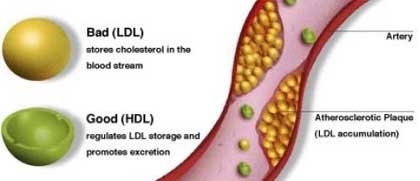 Cholesterol and Tinnitus