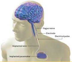 An Animal Model of Tinnitus