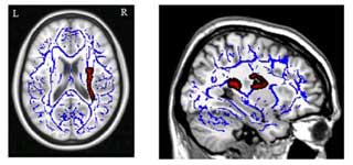 Hearing Loss, Tinnitus and Brain Change