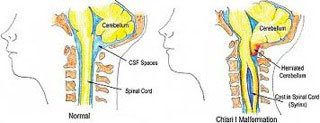 Head and Neck Injuries Cause Tinnitus