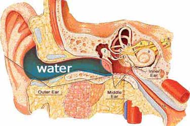 Swimmer’s Ear