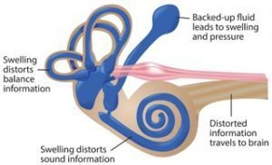 Meniere’s Disease