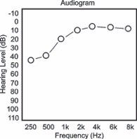 meniere's disease audiogram