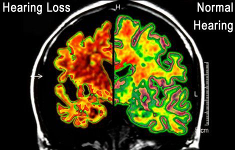 Untreated Hearing Loss Causes Cognitive Decline